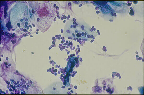 マラセチア皮膚炎の原因